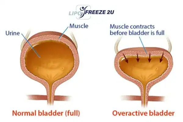 diagram of overactive bladder treatment Llanelli