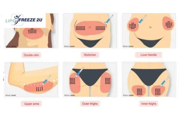 Benefits of Choosing Aqualyx for Fat Reduction Llanelli