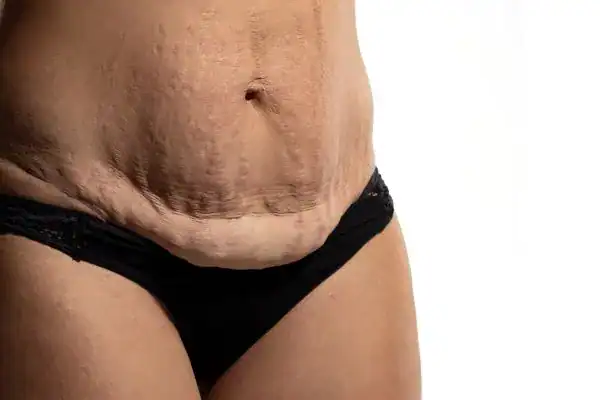 loose skin after weight loss injections Llanelli