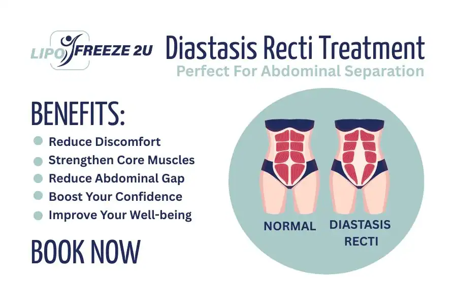 How Long Will It Take to See Improvements in Diastasis Recti Llanelli