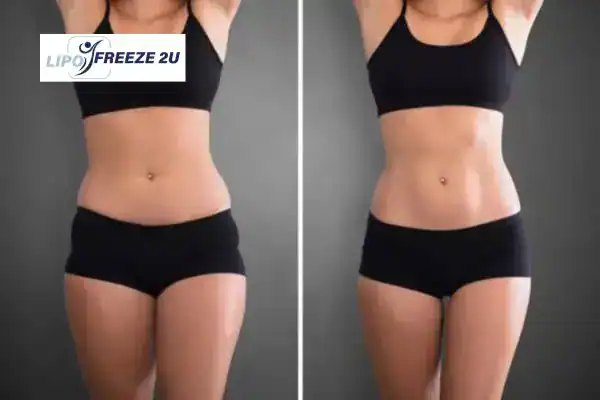 How Can LIPO FREEZE 2U Support Your Post-Pregnancy Body Recovery Llanelli?