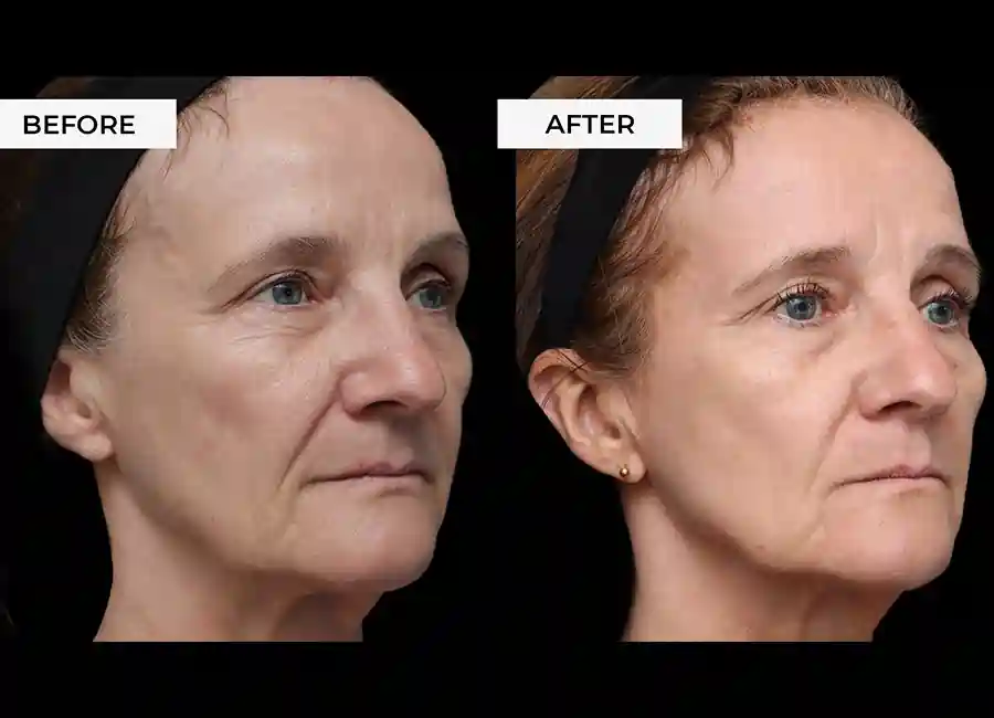 How Many RF Microneedling Sessions Will You Need to See a Difference Llanelli?