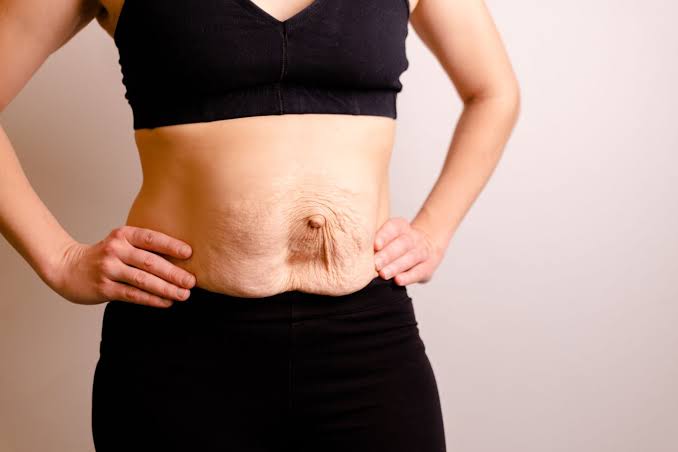 Is Surgery Really the Only Way to Repair Diastasis Recti Llanelli?
