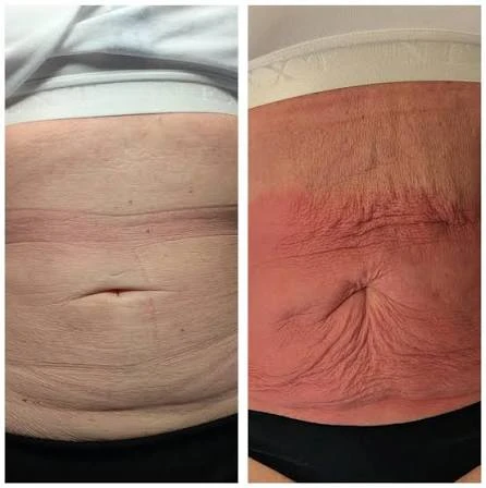 How Does RF Microneedling Improve Crepey, Thin and Uneven Skin Texture Llanelli?