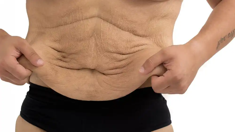 RF Microneedling for Loose Skin: How Can It Help Tighten and Reshape the Skin Llanelli?